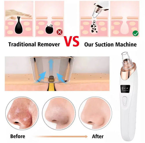 5-in-1 Rechargeable Blackhead Remover & Face Vacuum